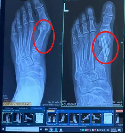 Bonex Bunion Correction Device