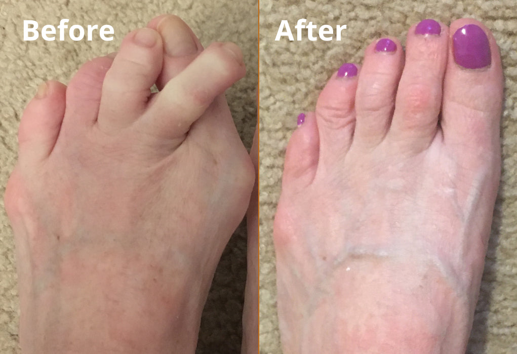 Bonex Bunion Correction Device
