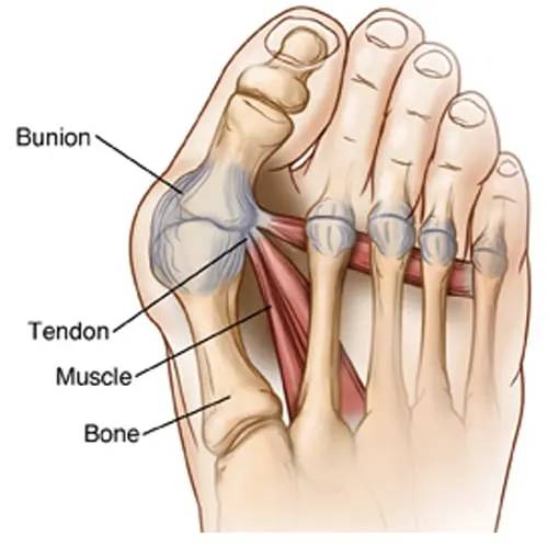 Bonex Bunion Correction Device