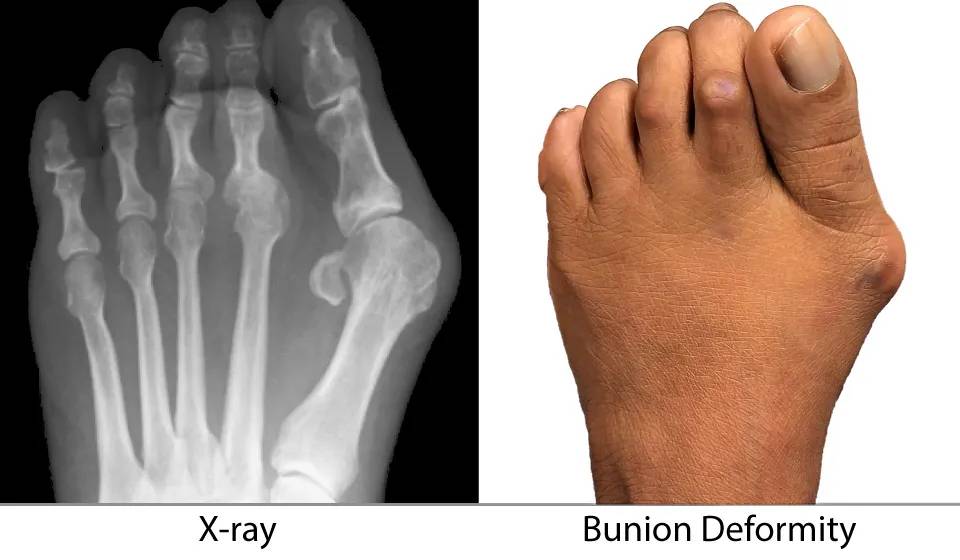Bonex Bunion Correction Device